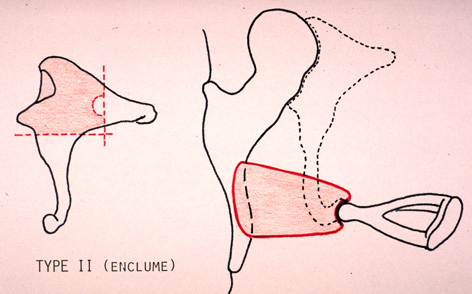 Bougie d'oreille : définition, dangers potentiels et alternatives