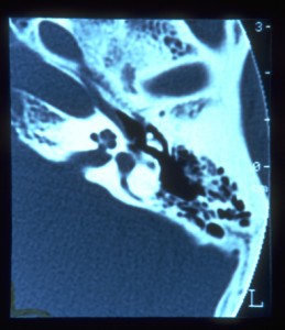 Figure 13 : examen CT de l'oreille