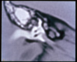 Figure 14 : examen IRM de l'oreille