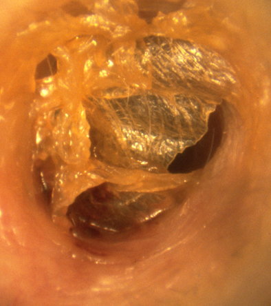 Cérumen : anatomie, bouchon d'oreille, traitements