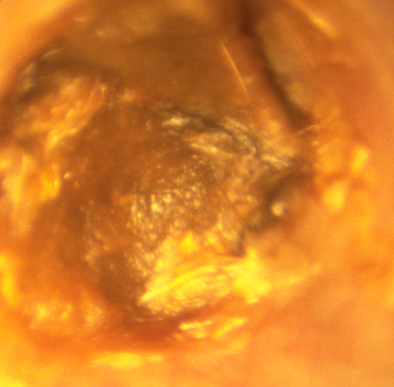 Qu'est-ce qu'un bouchon de cérumen dans l'oreille ?