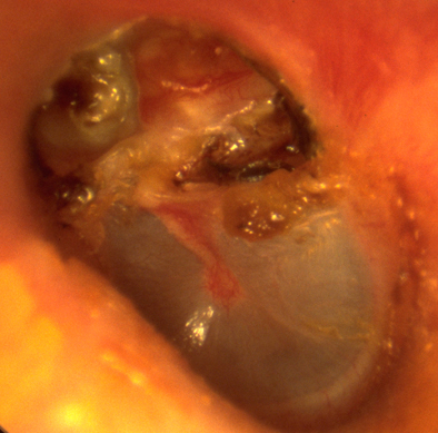 Le cholestéatome | Otologie - Dr Albert Mudry