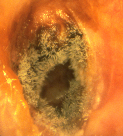 Bouchon de cire  Otologie - Dr Albert Mudry