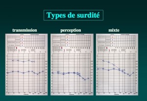 Schéma: Types de surdité