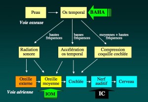 Schéma: Implants auditifs